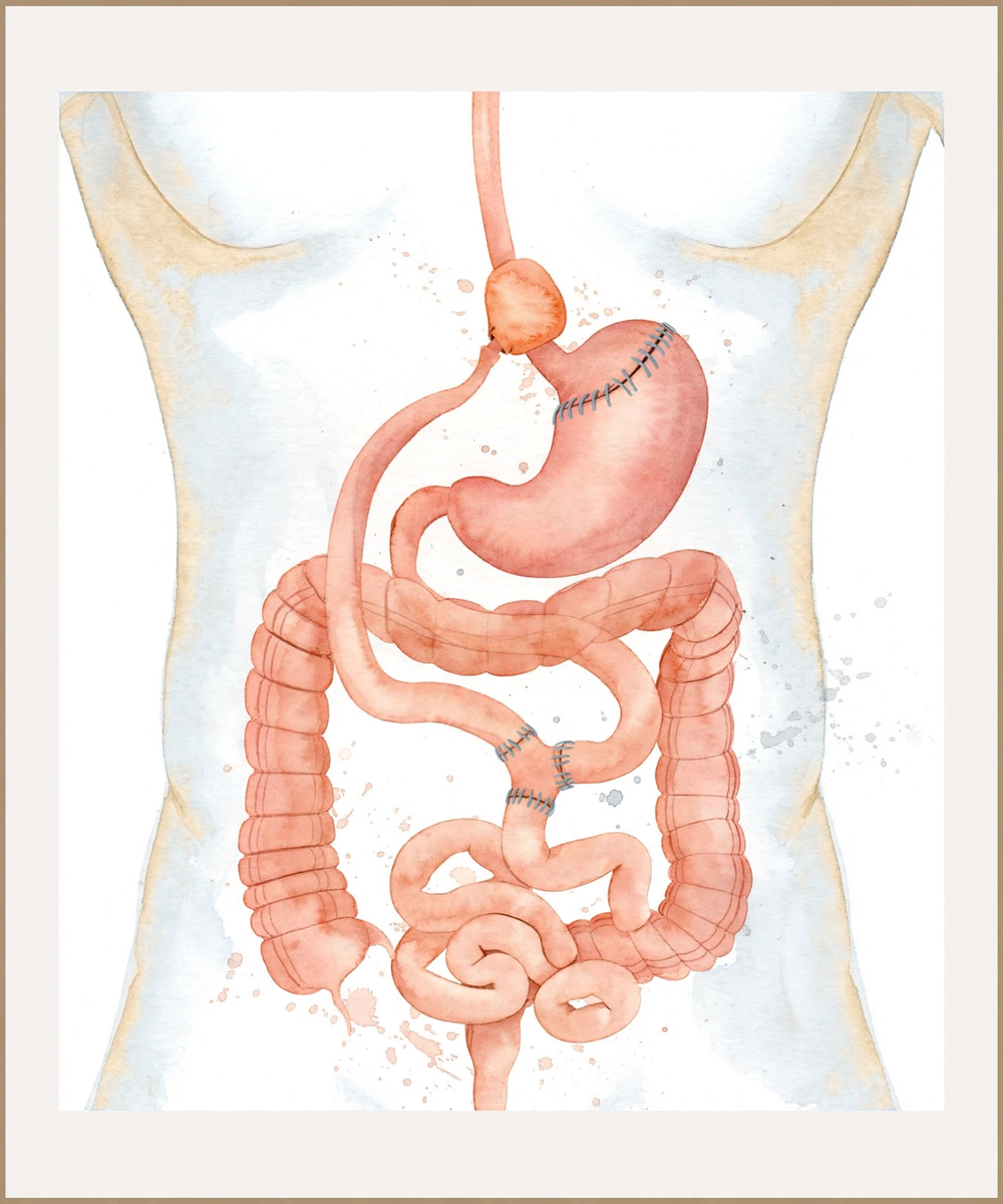 Illustration of a Roux-en-Y gastric bypass