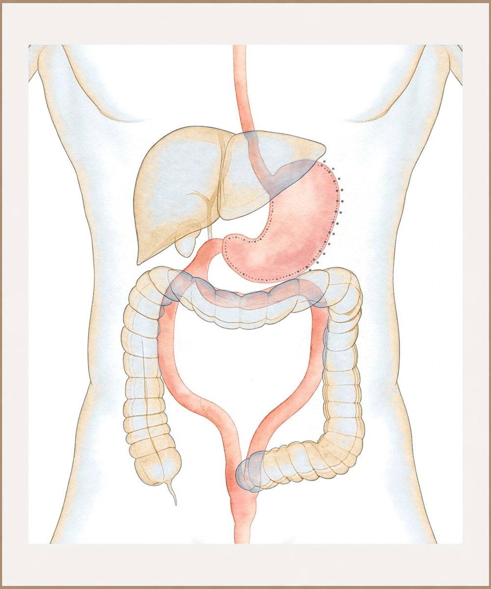 Illustration of a biliopancreatic diversion with duodenal switch