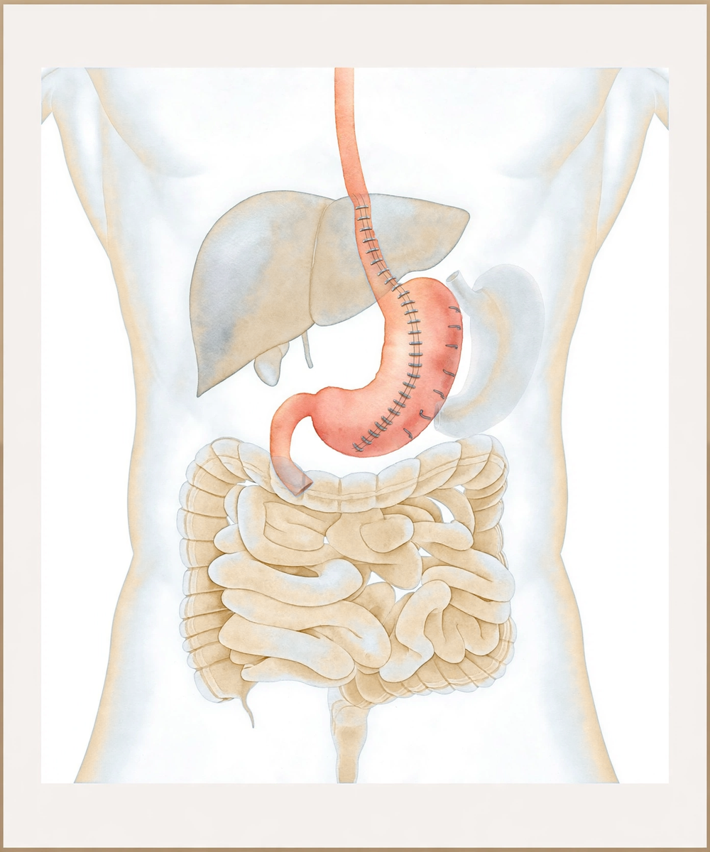 Illustration of a sleeve gastrectomy